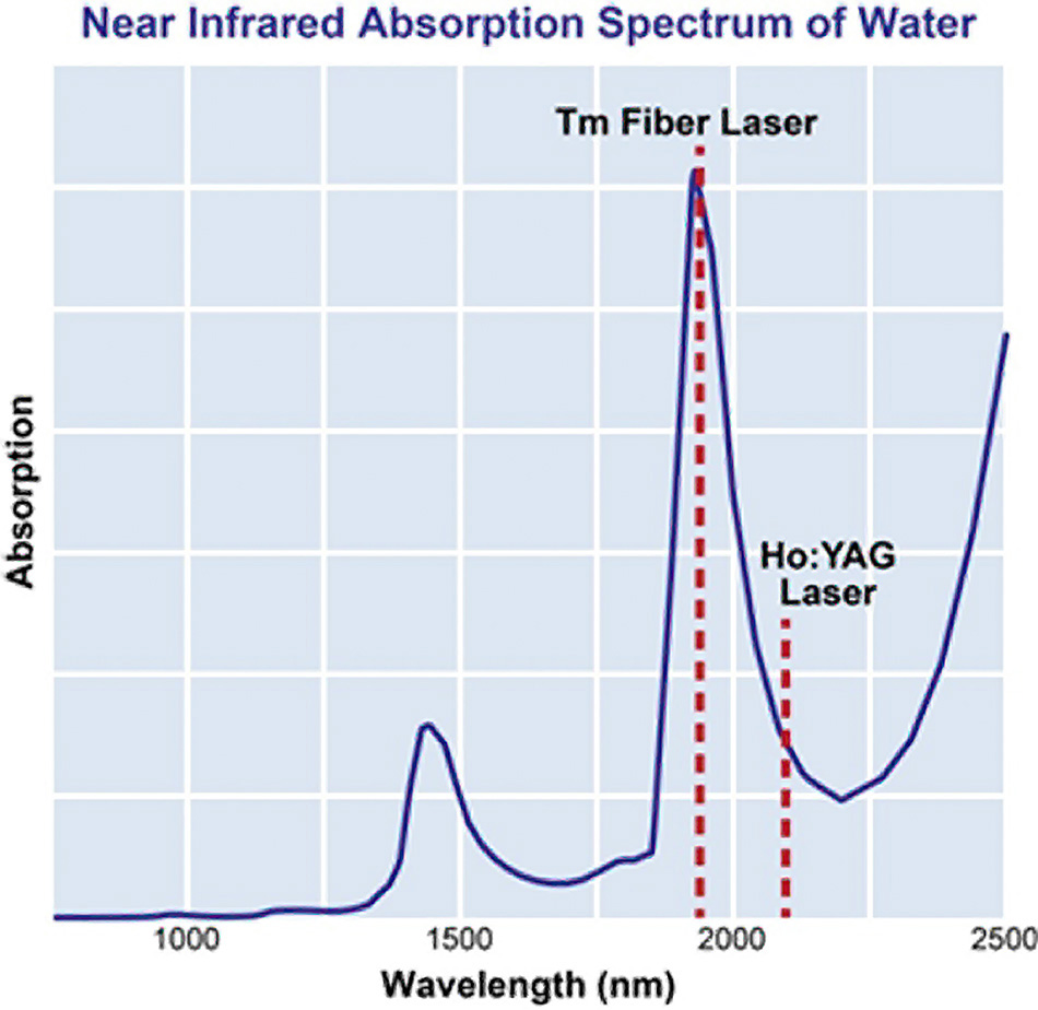 A TFL Delivers Significant Advantages for Laser Lithotripsy