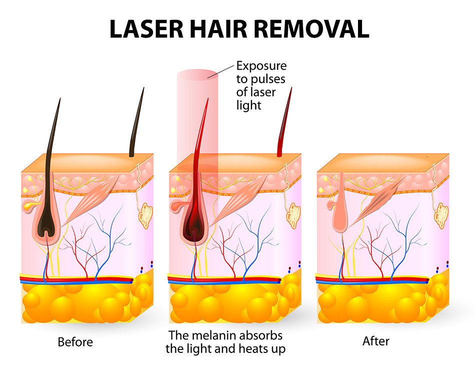 Diode Laser Hair Removal