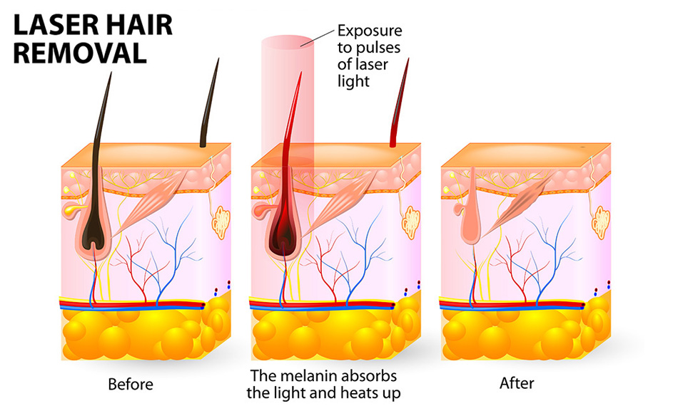 WHAT'S THE DIODE LASER?