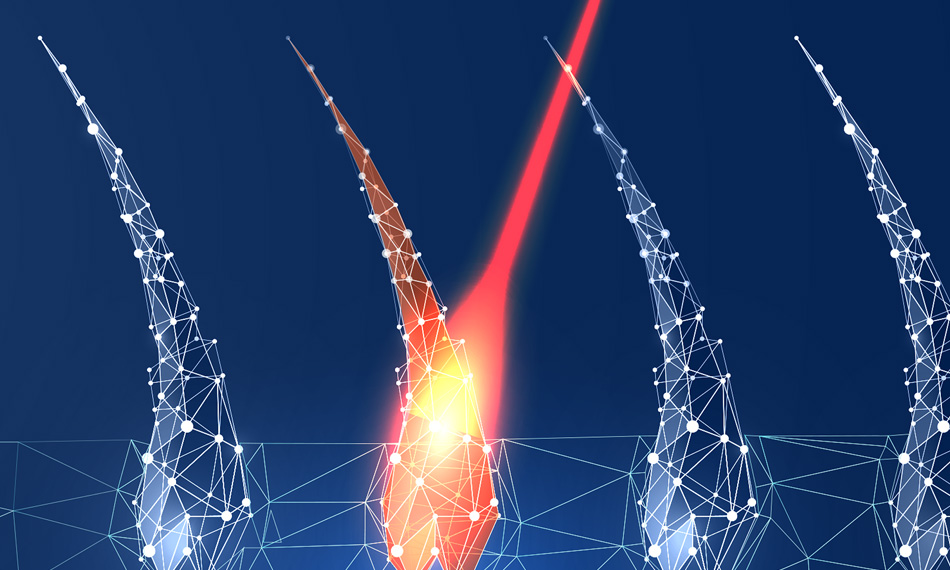 Laser Hair Removal