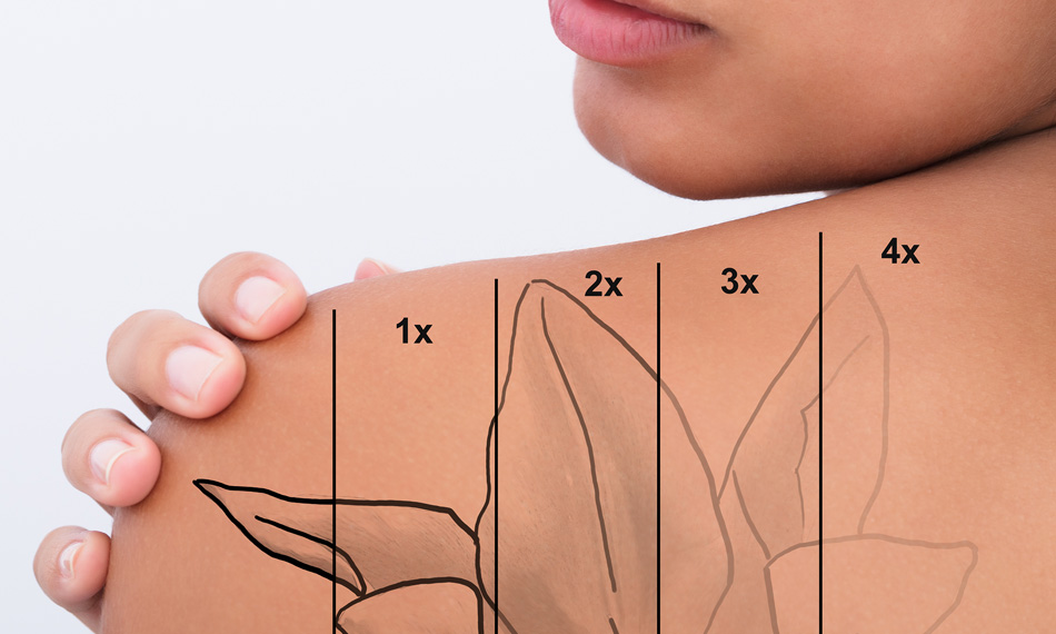 Laser Tattoo Removal