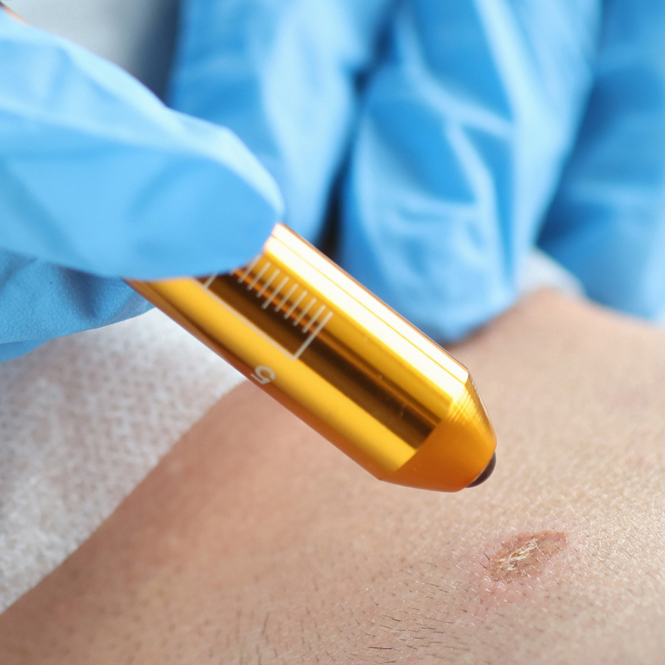 Surgical Lasers